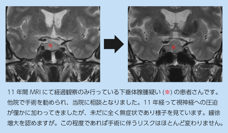 下垂体腫瘍の疑いがあるMRI画像