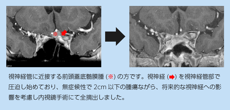 視神経管に近接する前頭蓋底髄膜腫の例